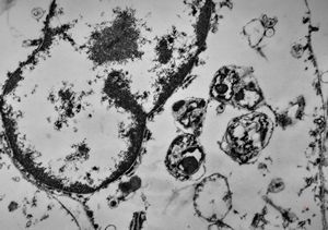 F,49y. | phagocytosed microbes - purulent meningitis F,49y. | phagocytosed microbes - purulent meningitis
